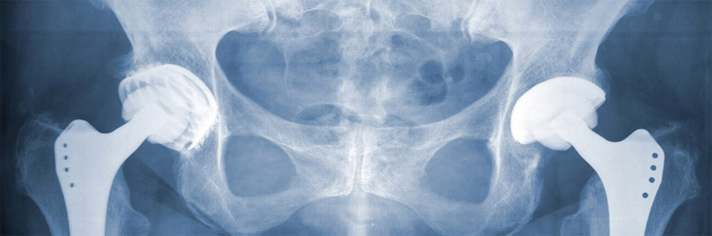 Pelvic joint replacement ayhcare